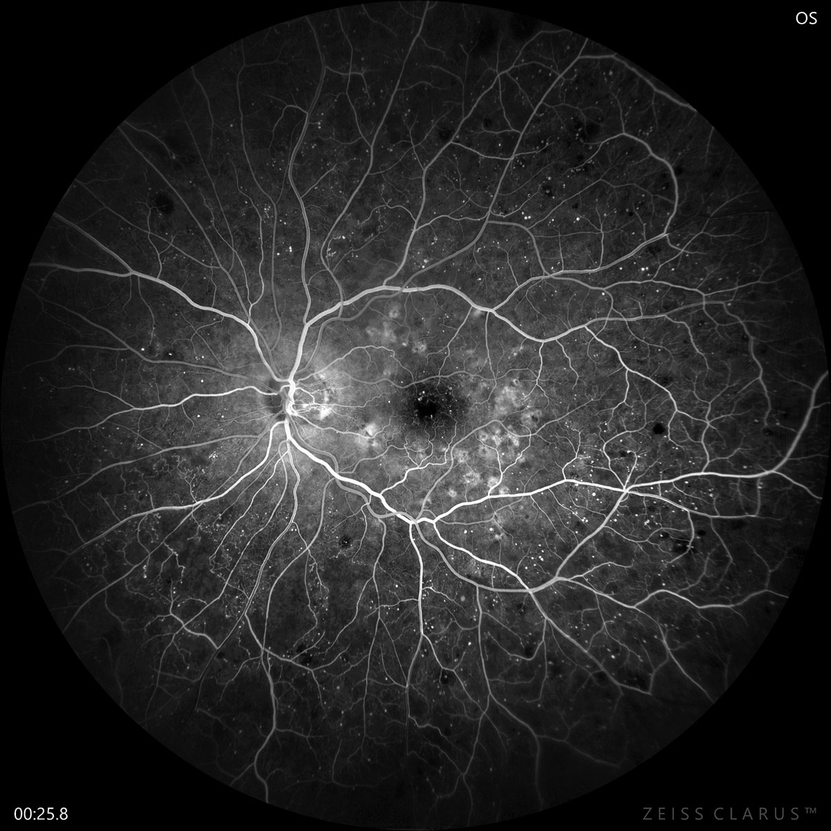 nearly-half-of-all-diabetes-patients-experience-retinopathy